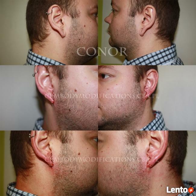Modyfikacje ciala-skaryfikacje, rekonstrukcja uszu i inne.