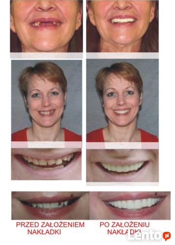 Sztuczne zeby-nakladki na zeby-INSTANT SMILE FIT-Nowosc