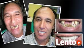 Sztuczne zeby-nakladki na zeby-INSTANT SMILE FIT-Nowosc