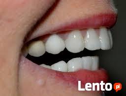 Sztuczne zeby-nakladki na zeby-INSTANT SMILE FIT-Nowosc