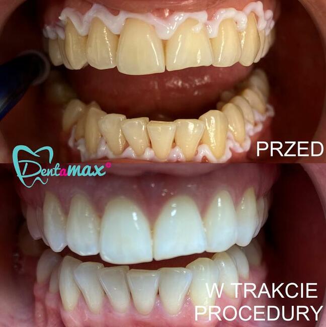 Skuteczne wybielanie zębów Kraków - Dentamax Nowosądecka 46