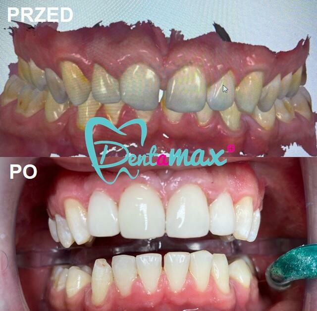 Skuteczne wybielanie zębów Kraków - Dentamax Nowosądecka 46