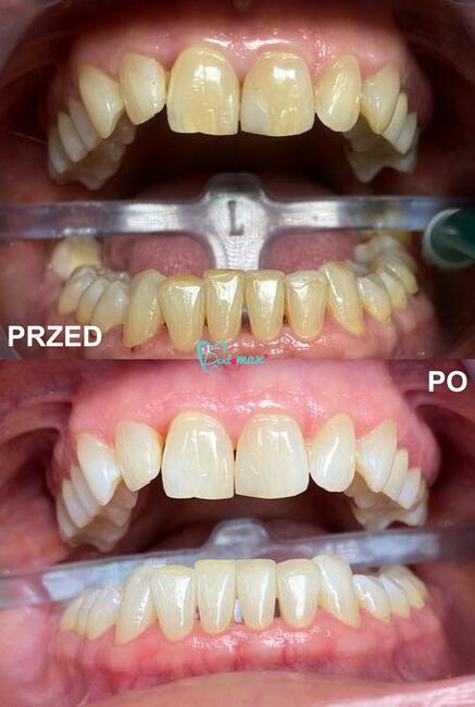 Skuteczne wybielanie zębów Kraków - Dentamax Nowosądecka 46
