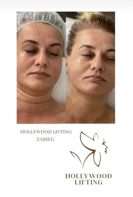 Naturalny Botoks - Hollywood Lifting Massage