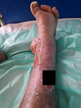 Pilna pomoc cegiełka 10 zł Udaje się uniknąć amputacji