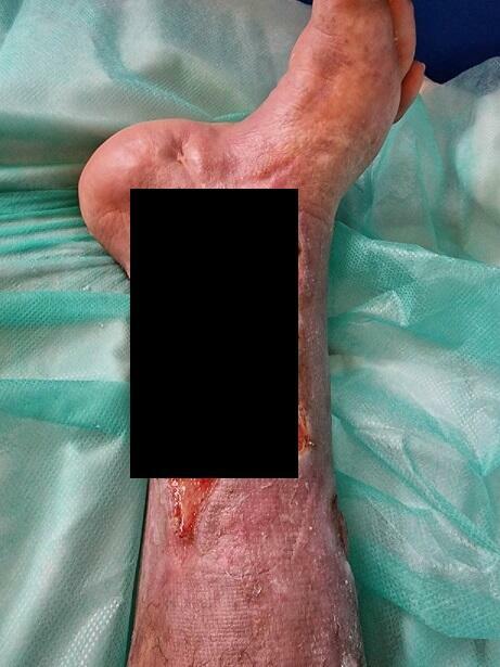 Pilna pomoc cegiełka 10 zł Udaje się uniknąć amputacji