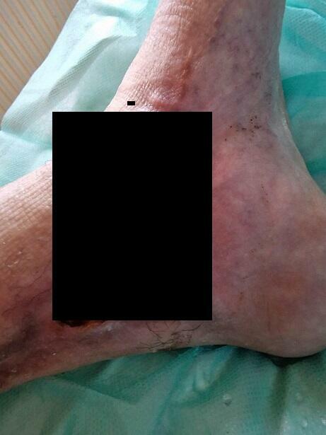 Pilna pomoc cegiełka 10 zł Udaje się uniknąć amputacji