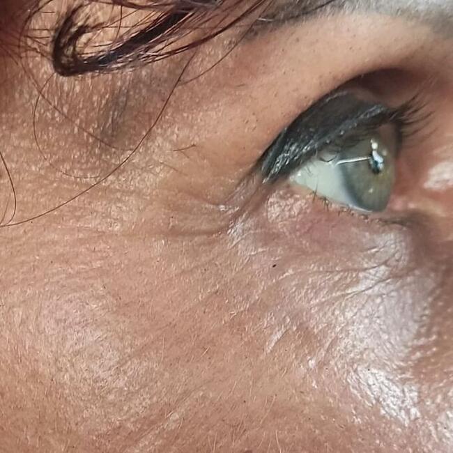 Zabiegi Plasmą Gold Lifting