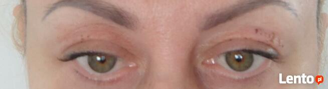 Zabiegi Plasmą Gold Lifting