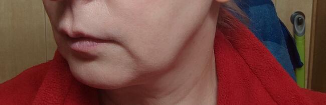 Zabiegi Plasmą Gold Lifting