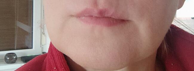 Zabiegi Plasmą Gold Lifting