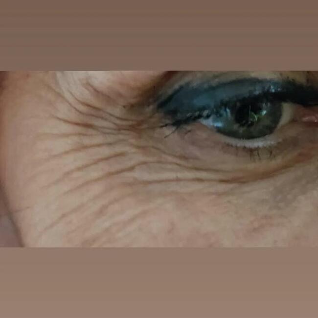 Zabiegi Plasmą Gold Lifting