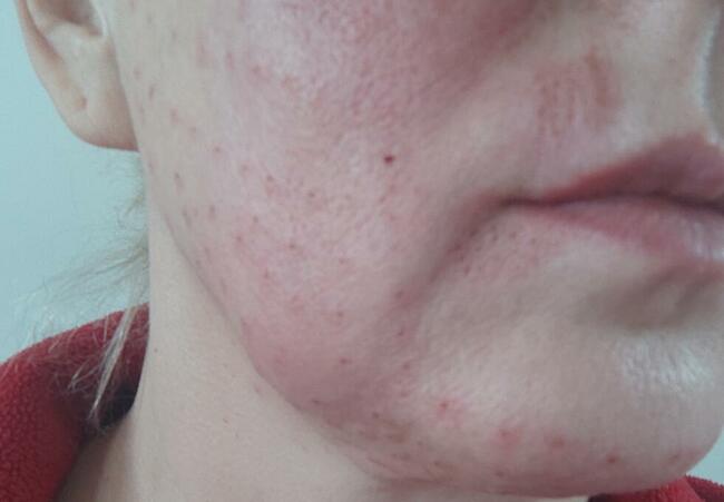 Zabiegi Plasmą Gold Lifting