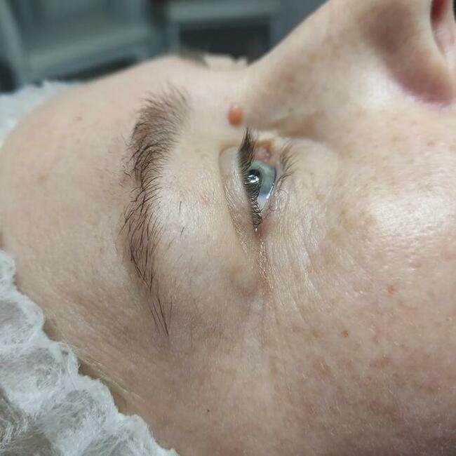 Zabiegi Plasmą Gold Lifting