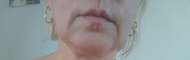 Zabiegi Plasmą Gold Lifting