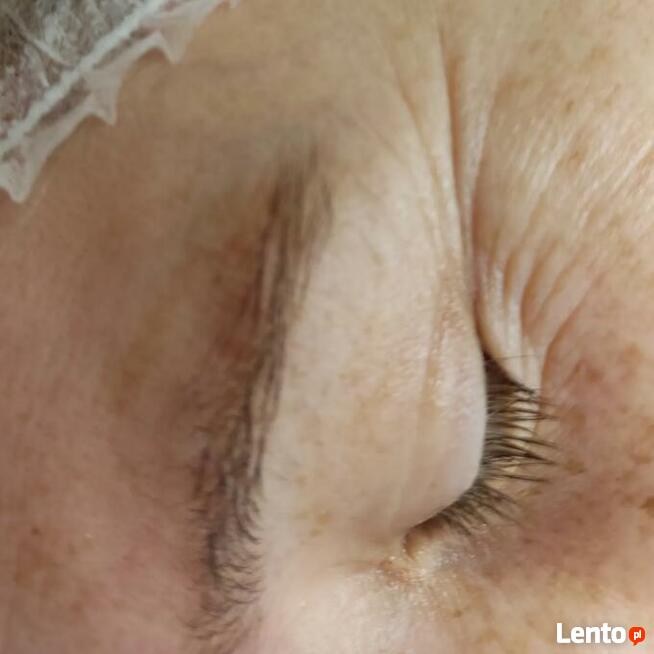 Zabiegi Plasmą Gold Lifting