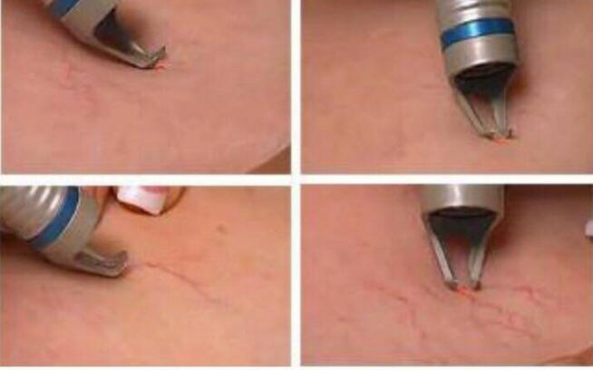 Egzosomy + radiofrekwencja mikroigłowa