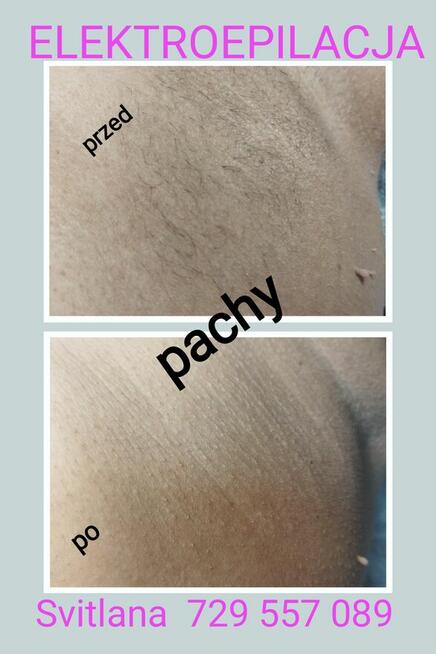 ELEKTROEPILACJA