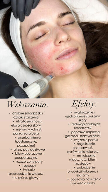 Laminacja brwi, mezoterapia mikroigłowa
