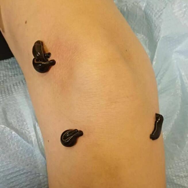 Masaże, hirudoterapia tlenoterapia