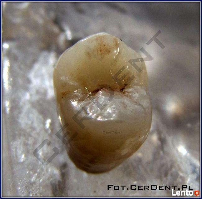 Naprawa Protez Pogotowie Protetyczne Warszawa