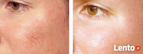 V-3000 Zamykanie naczynek koagulacja RF wysoka częstotliwość