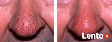 V-3000 Zamykanie naczynek koagulacja RF wysoka częstotliwość