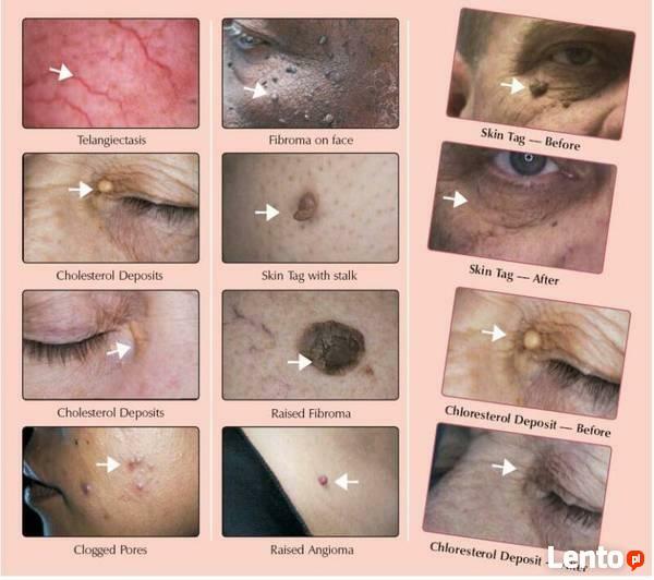 V-3000 Zamykanie naczynek koagulacja RF wysoka częstotliwość