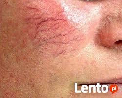 V-3000 Zamykanie naczynek koagulacja RF wysoka częstotliwość