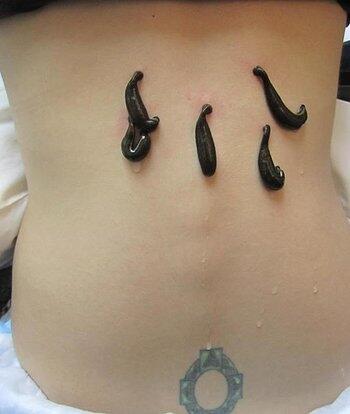 Leczenie Pijawkami Lekarskimi Natur Wit Bytom