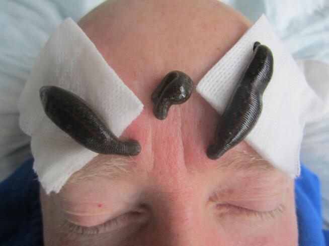 Leczenie Pijawkami Lekarskimi Natur Wit Bytom