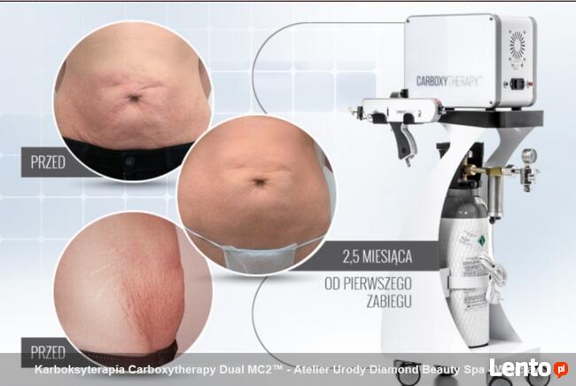 Carboxytherapy karboksyterapia-odchudzanie,ujędrnienie skóry
