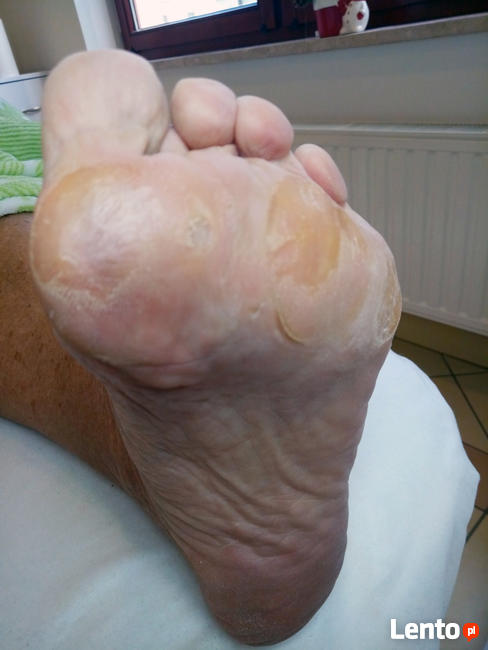 Podolog Bochnia - zdrowe stopy