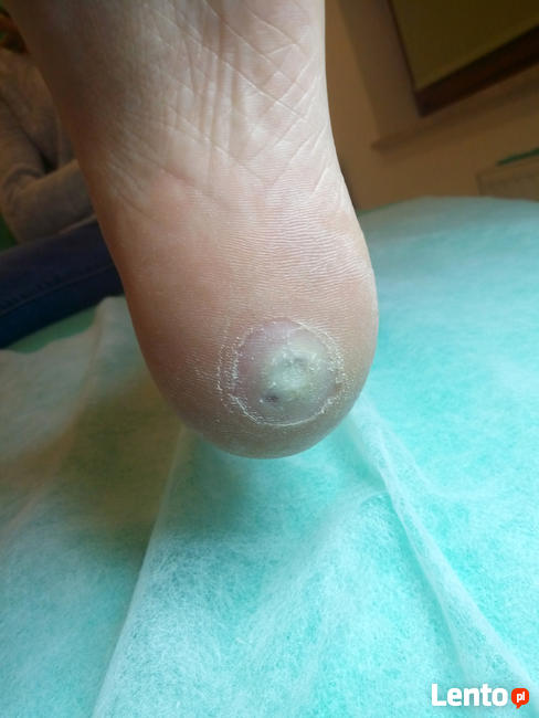 Podolog Bochnia - zdrowe stopy