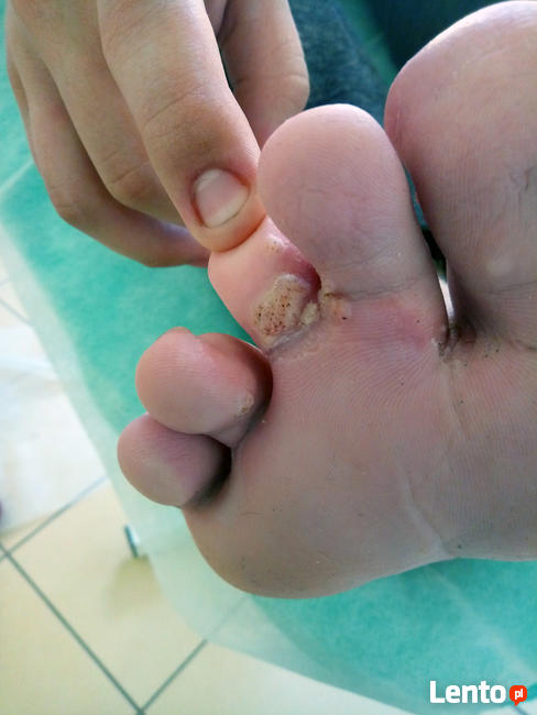 Podolog Bochnia - zdrowe stopy