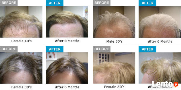 Laseroterapia NTL na porost włosów - urządzenie stymulujące