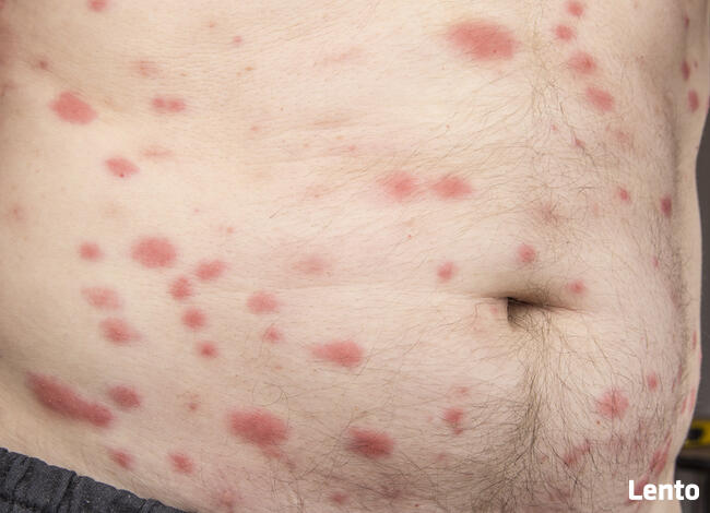 DEZYNSEKCJA PLUSKWY Warszawa, Odpluskwianie PLUSKWY