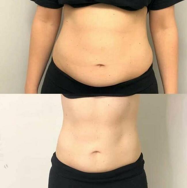 EMS Stymulator mięśni. Szkolenie + certyfikat. Odchudzanie.