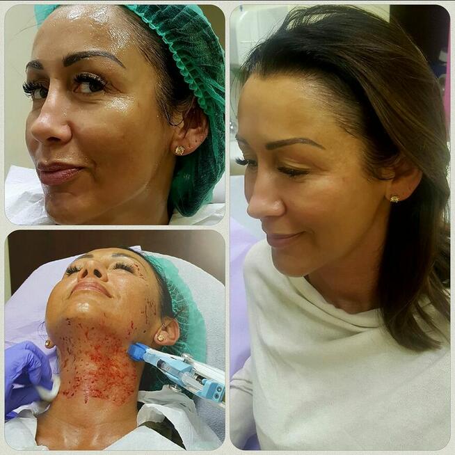 OSOCZE bogatopłytkowe.