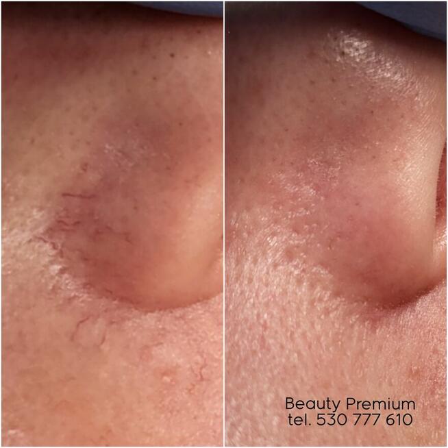 Bezbolesne zamykanie naczynek + konsultacja kosmetologa