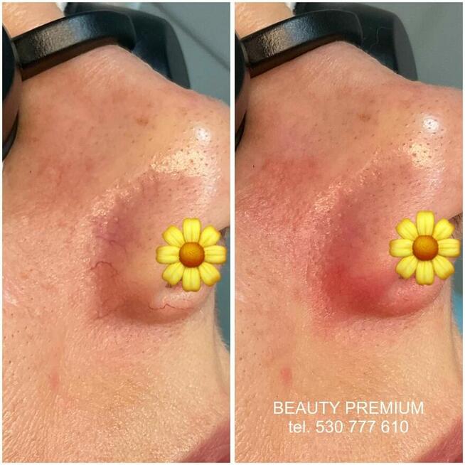 Bezbolesne zamykanie naczynek + konsultacja kosmetologa