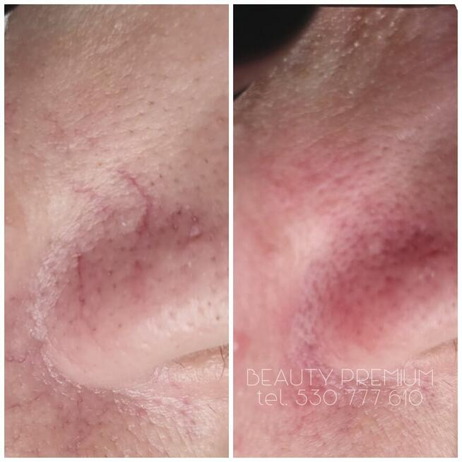 Bezbolesne zamykanie naczynek + konsultacja kosmetologa