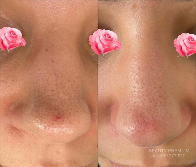 Bezbolesne zamykanie naczynek + konsultacja kosmetologa