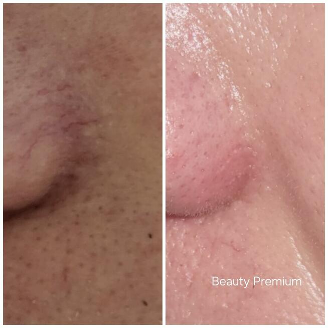 Bezbolesne zamykanie naczynek + konsultacja kosmetologa