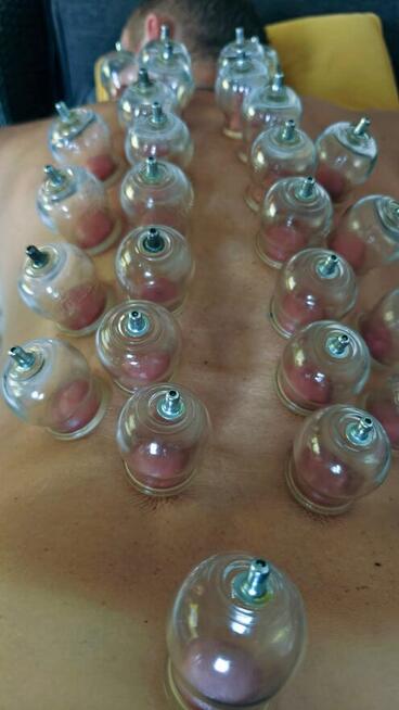 Terapie naturalne:pijawki, masaże, tlenoterapia w komorze jip