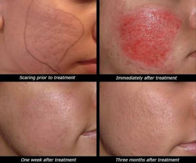 Mezoter.apia Mikroigłowa PROMOCJA