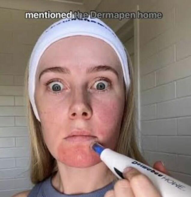 Mezoter.apia Mikroigłowa PROMOCJA