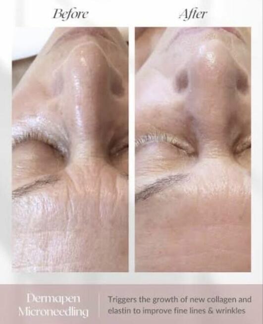 Mezoter.apia Mikroigłowa PROMOCJA