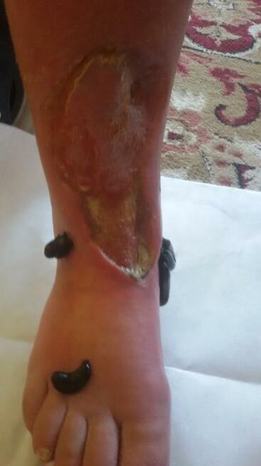 Hirudoterapia Leczenie pijawkami Jarocin Pleszew Ostrów Wlkp