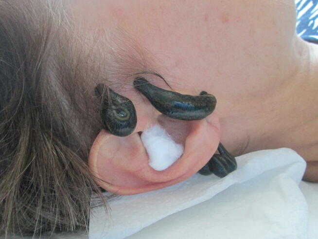 Hirudoterapia Leczenie pijawkami Jarocin Pleszew Ostrów Wlkp